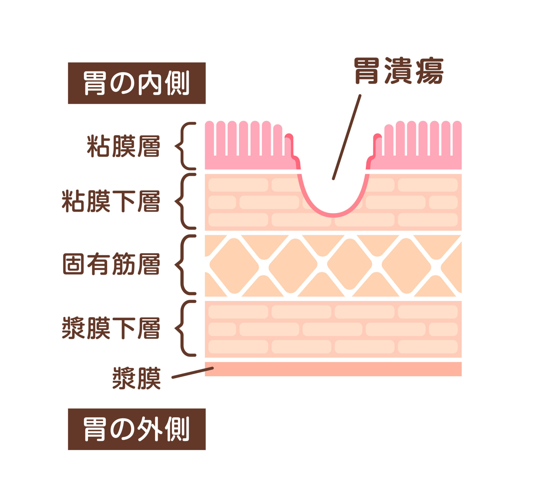 【イラスト】胃潰瘍の説明図