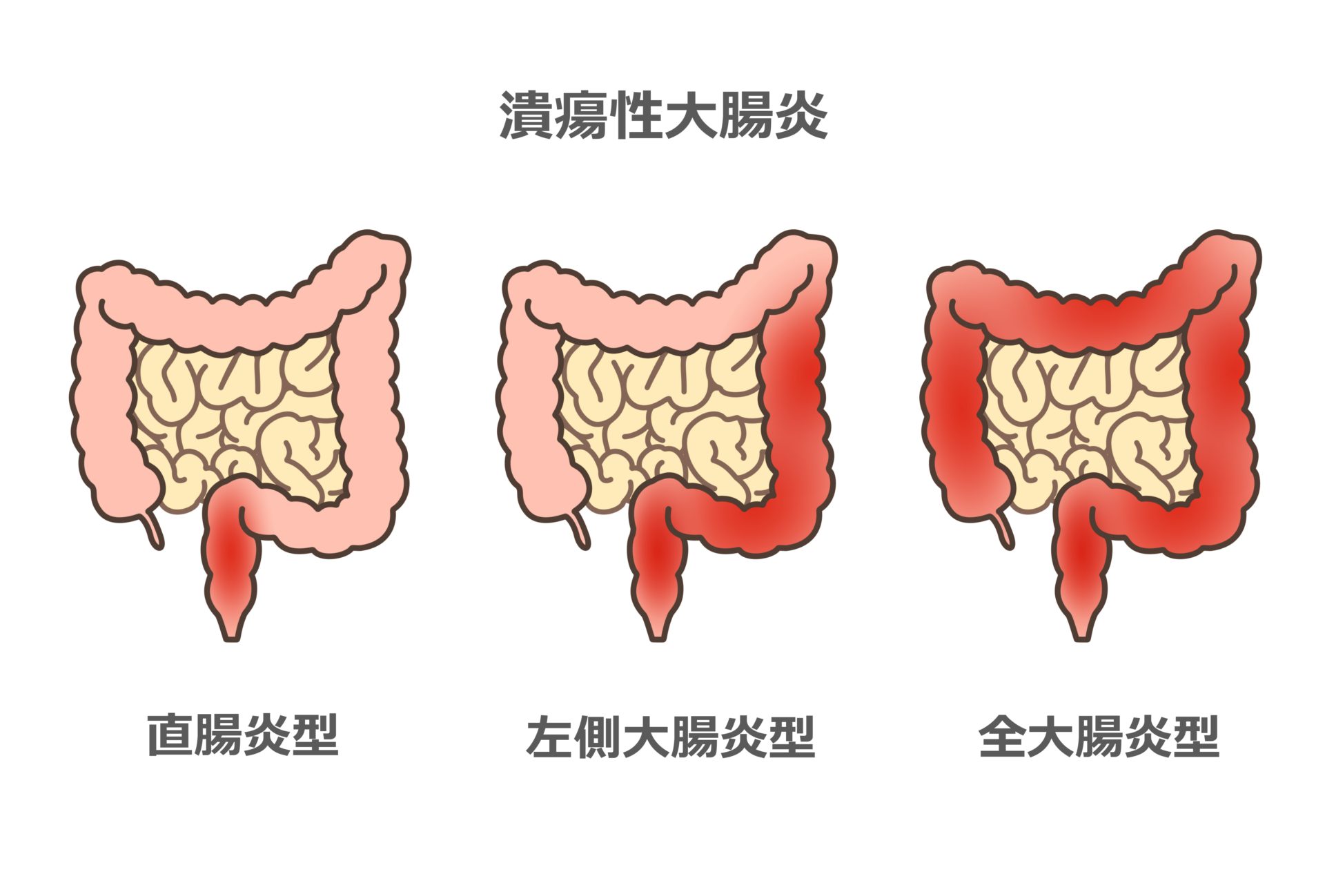 【イラスト】潰瘍性大腸炎直腸型