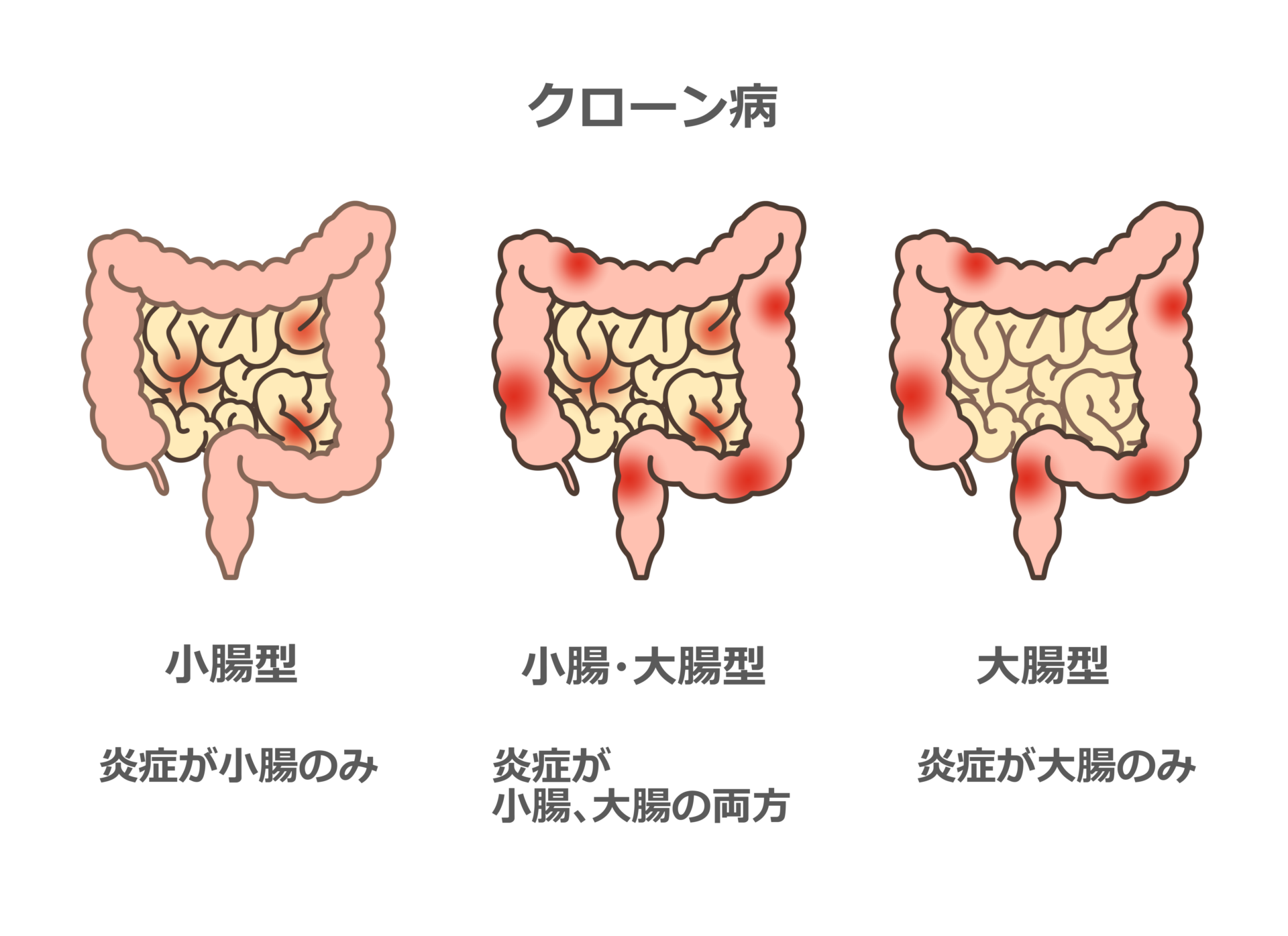 【イラスト】クローン病